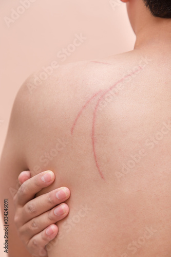 Wallpaper Mural scar scratch on man back in accident injury hand touch back pain Torontodigital.ca