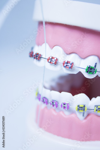 Model denture with metal orthodontics