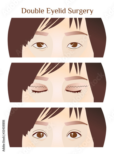 Step of narrow-eyed to double eyelid surgery