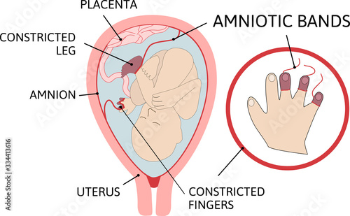 amniotic bands. fetus is entangled in fibrous string-like amniotic bands in the womb