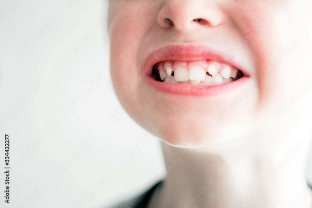 Foto Stock Baby teeth 7 years. Eruption of new permanent teeth. White