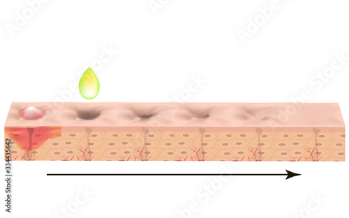 Atrophic scars. Acne scar. The anatomical structure of the skin with acne. Vector illustration on isolated background.