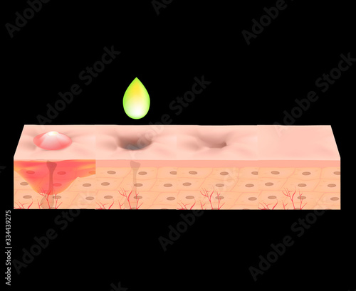 Atrophic scars. Acne scar. The anatomical structure of the skin with acne. Vector illustration.