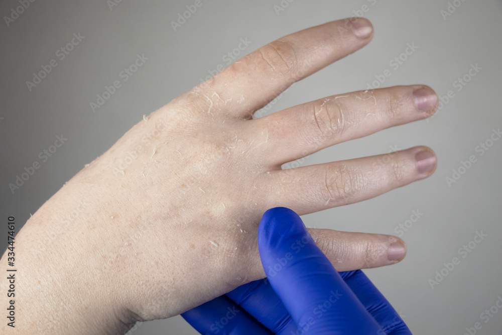 Dry hands and peeling of the skin, mycosis. The girl shows her hands to