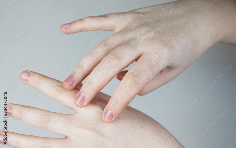 Naklejka premium Dry hands and peeling of the skin, mycosis. The girl shows her hands to a doctor dermatologist. Moisturizing the hands and treating the fungus on the fingers