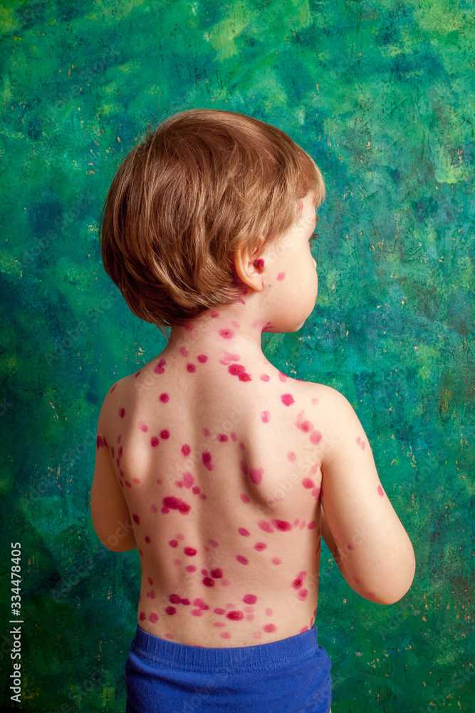 ,boy with chickenpox. Sick child with chickenpox. Varicella virus or