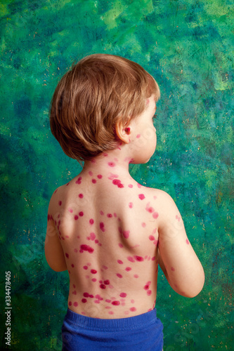 Obraz na płótnie ,boy with chickenpox