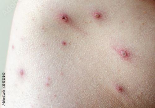 Obraz na plátně Large spots and pimples acne on the body - adult body with chickenpox