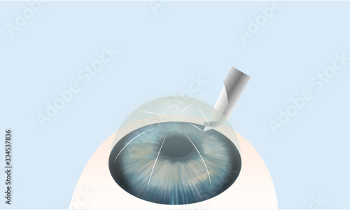 Radial keratotomy (RK) is a refractive surgical