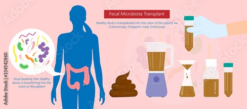 Fecal microbiota transplant (FMT) stool transferring bacteria microbes 
