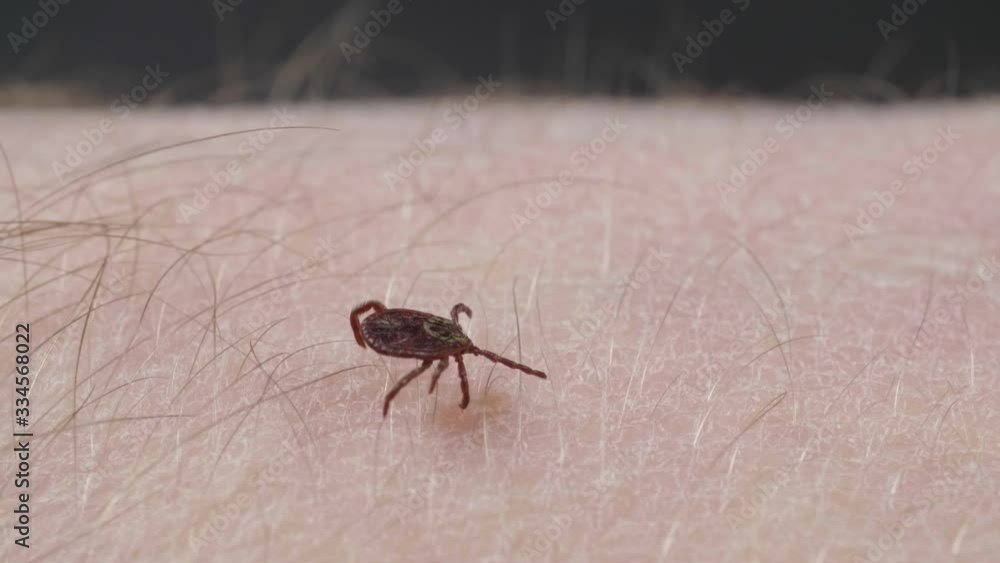 Blood-sucking mite tick creepes on the human skin through the hair Blood-sucking mite tick creepes on the human skin through the hair