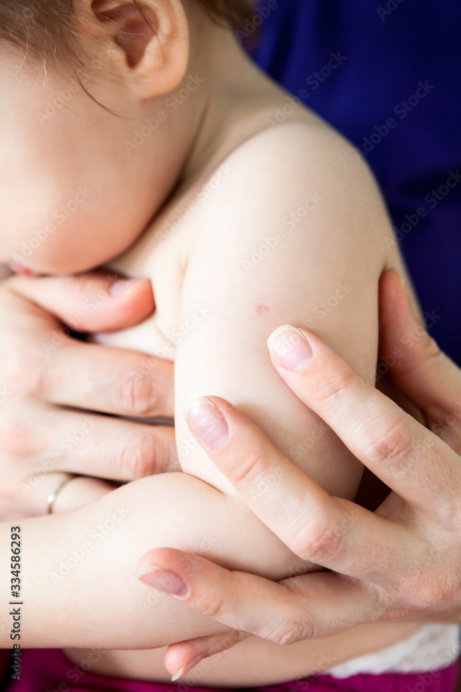 BCG vaccine - mark is on a baby’s shoulder, close-up view BCG vaccine - mark is on a baby’s shoulder, close-up view
