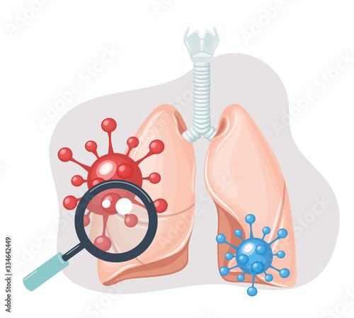 Human lungs. Sars disease, coronaviruses in the lung. Coronavirus