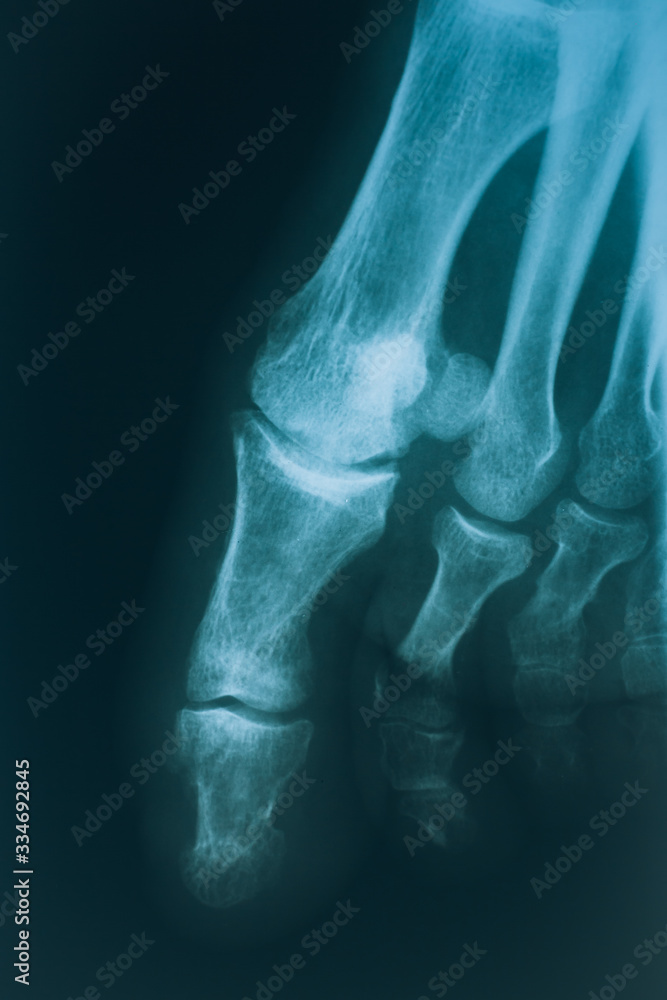X-ray of the toes. Leg injury, real x-ray with foot X-ray of the toes. Leg injury, real x-ray with foot