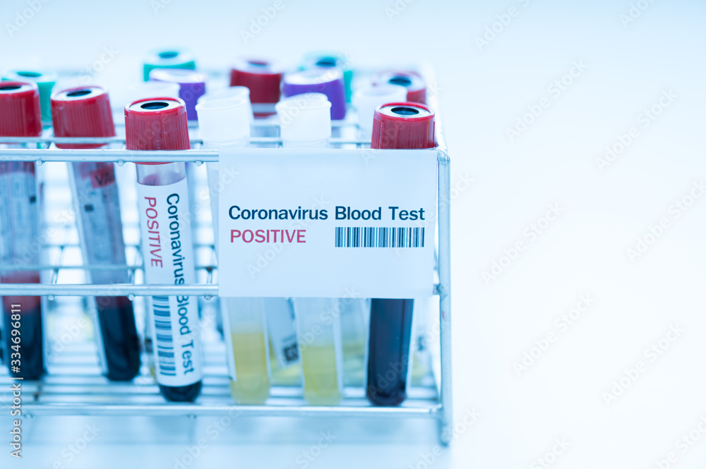 Blood test tube  for laboratory analysis.Laboratory testing patient’s blood samples.Conceptual image coronavirus (COVID-19) test tube sample that has tested positive for coronavirus.