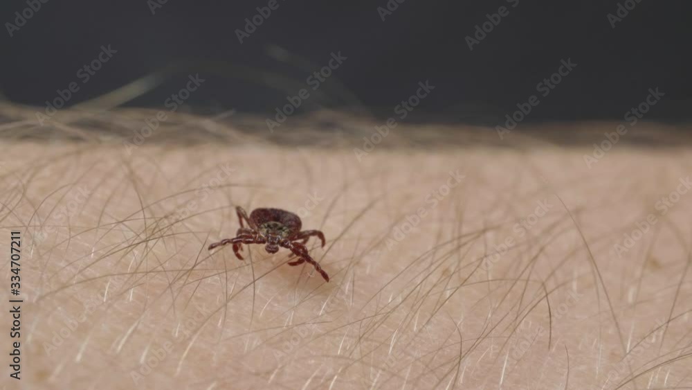 Blood-sucking mite tick creepes on the human skin through the hair Blood-sucking mite tick creepes on the human skin through the hair