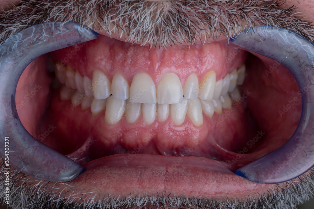 macro photo of human teeth