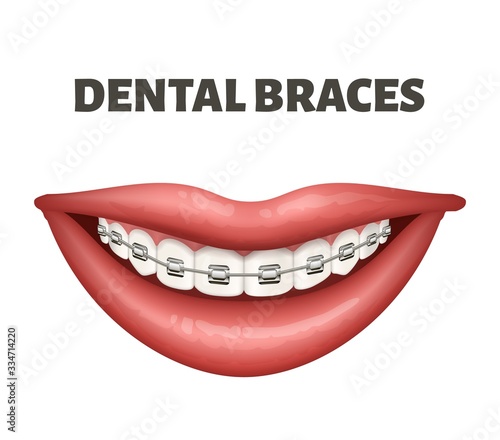 Vector illustration of the dental braces. Image showing human smile and braces on the white teeth.