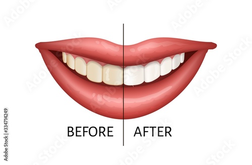Teeth before and after whitening process. Medical design concept. Vector illustration isolated on the white background.