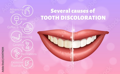 Medical poster showing causes of tooth discoloration. Educational infographic concept. Realistic vector illustration.