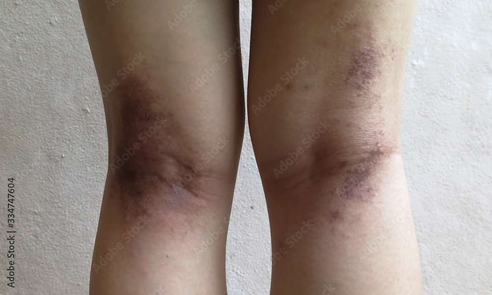 Atopic dermatitis on legs. medical concept Atopic dermatitis on legs. medical concept
