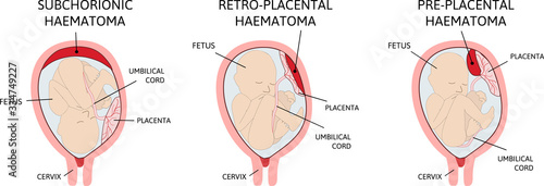 Placental hematomas. blood clots that arise from the placenta.