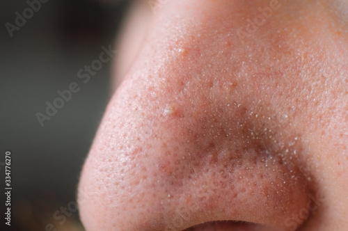Clogged pores. Problematic skin. Post-acne, scars and red festering pimples on the face of a young man. photo