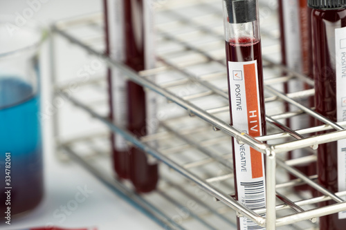 Test tube with blood sample in lab for HIV test, laboratory sample of blood testing for diagnosis virus infection, AIDS infectious concept