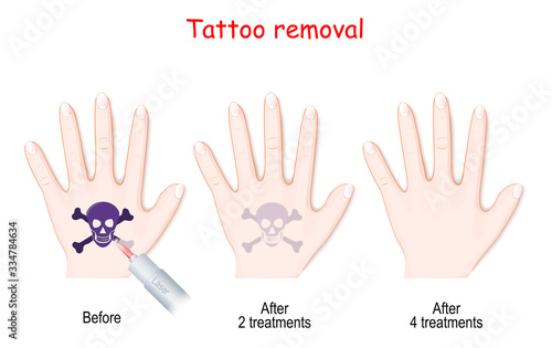 Laser tattoo removal.