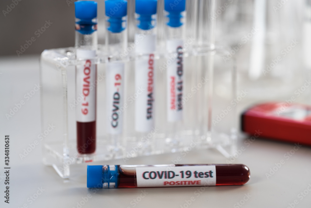 Nurse holding test tube with blood for nCoV-2019 analyzing, coronavirus test concept in laboratory Nurse holding test tube with blood for nCoV-2019 analyzing, coronavirus test concept in laboratory