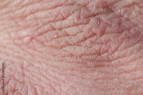 background with the texture of pink weathered human hand skin covered with deep wrinkles and dry scales and cracks
