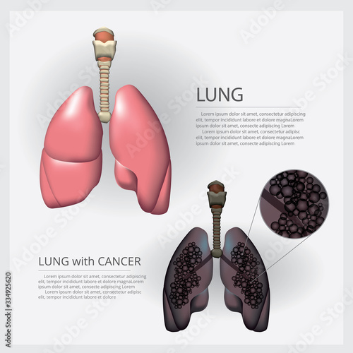Lung with Detail and Lung Cancer Vector Illustration
