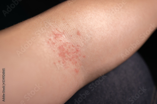 Skin allergic to chemicals causing a rash on the arms, legs, neck and body.