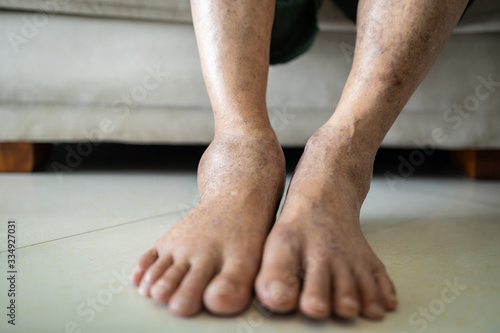 Photography Asian senior woman is show her swollen feet or legs in the area of astragalus,el