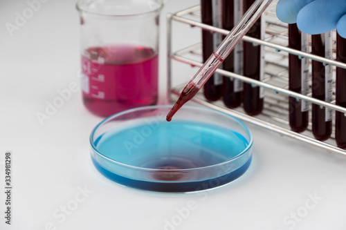 Methylene blue test liquid with blood sample for test, laboratory sample of blood testing for diagnosis virus infection, the pandemic infectious concept