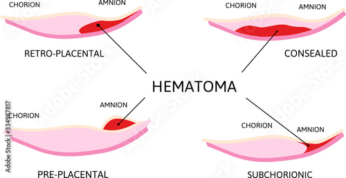 Placental hematoma. blood clots that arise from the placenta. Depending on their location it is retro-placental, subchorionic or preplacental.