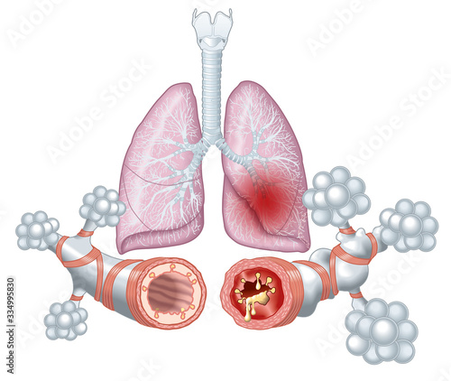 Foto Asthma, normal and asthmatic airways, medically illustration