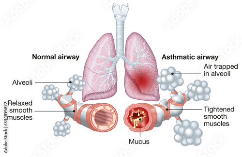 Asthma, normal and asthmatic airways, medically illustration photo