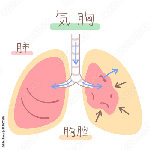肺の図表（気胸）