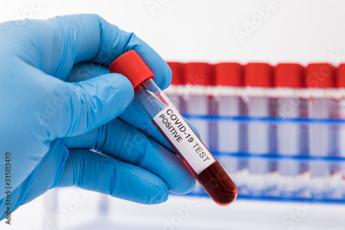 Blood sample tube positive with COVID-19 virus or novel coronavirus 2019