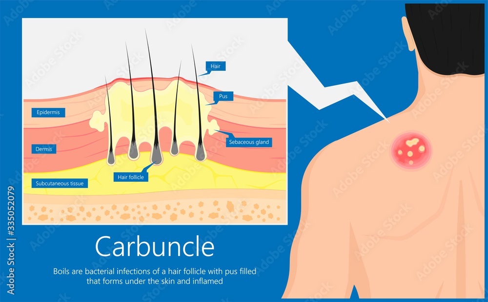 Carbuncle Boils bacterial infection under skin hair follicle pus head  irritated lump soap swollen Methicillin resistant MRSA antibiotic exam  Stock Vector | Adobe Stock