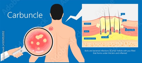Carbuncle Boils bacterial infection under skin hair follicle pus head irritated lump soap swollen Methicillin resistant MRSA antibiotic exam