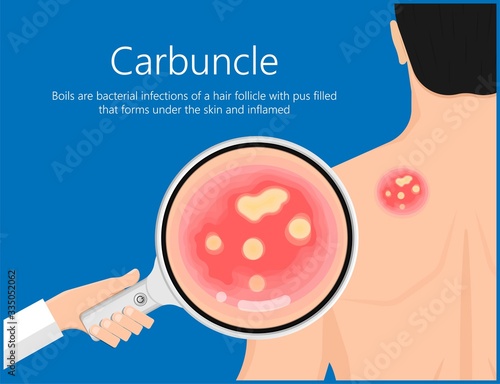 Carbuncle Boils bacterial infection under skin hair follicle pus head irritated lump soap swollen Methicillin resistant MRSA antibiotic exam