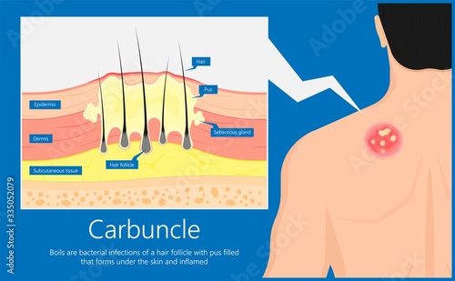 Carbuncle Boils bacterial infection under skin hair follicle pus head irritated lump soap swollen Methicillin resistant MRSA antibiotic exam