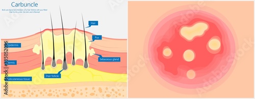 Carbuncle Boils bacterial infection under skin hair follicle pus head irritated lump soap swollen Methicillin resistant MRSA antibiotic exam