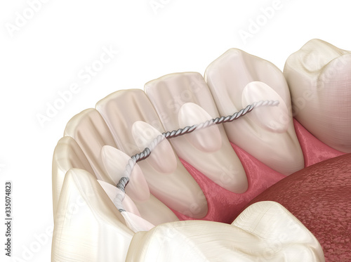 Foto Retainers dental installed after braces treatment, Medically accurate dental 3D