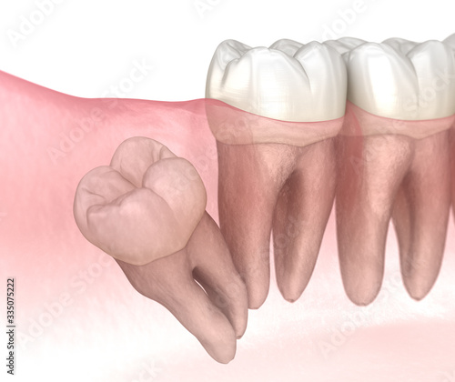 Distal impaction of Wisdom tooth. Medically accurate tooth 3D illustration photo