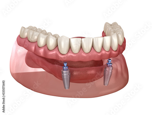 Mandibular removable prosthesis All on 2 system supported by implants with ball attachments. Medically accurate dental 3D illustration