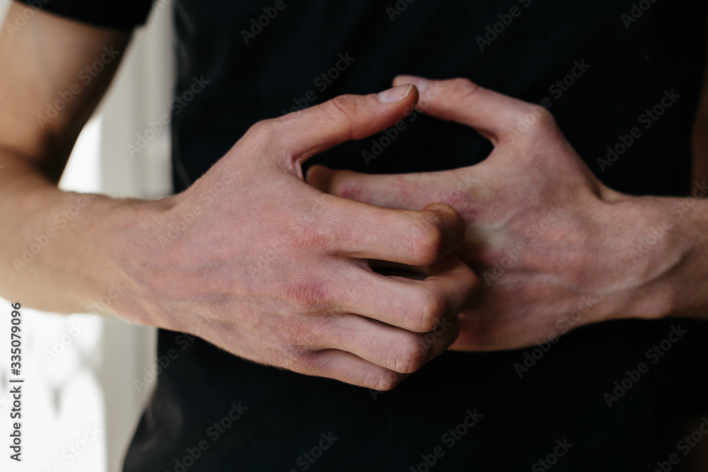 Cracked, flaky skin on the hands. Dermatological problems of psoriasis. Hard, cracked skin on