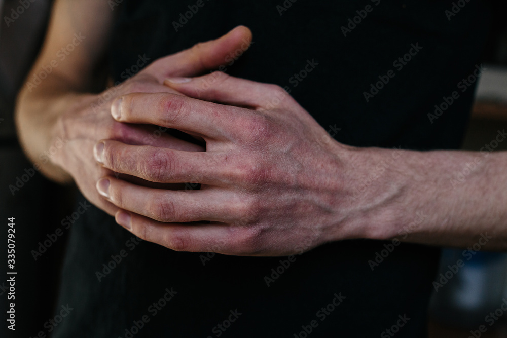 Cracked, flaky skin on the hands. Dermatological problems of psoriasis. Hard, cracked skin on the finger in a woman's hands. Hand stains, dry skin. Psoriasis, allergy